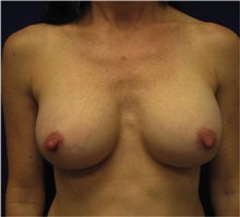 Breast Augmentation After Photo by Nicholas Leonardi, DO; ,  - Case 42428
