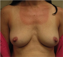 Breast Augmentation Before Photo by Nicholas Leonardi, DO; ,  - Case 42428