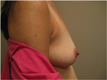 Breast Augmentation Before Photo by Nicholas Leonardi, DO; ,  - Case 42428