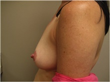 Breast Augmentation Before Photo by Nicholas Leonardi, DO; ,  - Case 42428