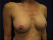 Breast Augmentation After Photo by Nicholas Leonardi, DO; ,  - Case 42428
