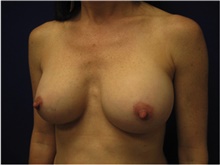 Breast Augmentation After Photo by Nicholas Leonardi, DO; ,  - Case 42428