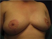 Breast Reconstruction After Photo by Nicholas Leonardi, DO; ,  - Case 42437
