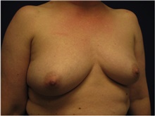 Breast Reconstruction Before Photo by Nicholas Leonardi, DO; ,  - Case 42437