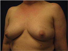 Breast Reconstruction Before Photo by Nicholas Leonardi, DO; ,  - Case 42437