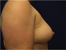 Breast Reconstruction Before Photo by Nicholas Leonardi, DO; ,  - Case 42437