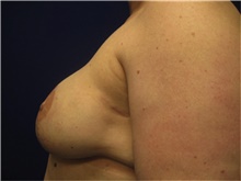 Breast Reconstruction After Photo by Nicholas Leonardi, DO; ,  - Case 42437