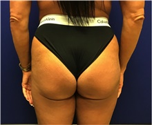 Buttock Lift with Augmentation Before Photo by Nicholas Leonardi, DO; ,  - Case 42442