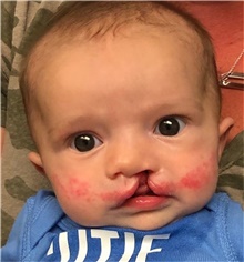 Cleft Lip and Palate Repair Before Photo by Rachel Ruotolo, MD; Garden City, NY - Case 42479