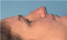 Rhinoplasty Before Photo by Mark Markarian, MD, MSPH, FACS; Wellesley, MA - Case 42539