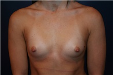 Breast Augmentation Before Photo by Larry Weinstein, MD; Chester, NJ - Case 42554