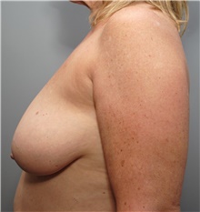 Breast Lift Before Photo by Ellen Mahony, MD; Westport, CT - Case 42702