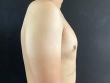 Male Breast Reduction After Photo by Sean Doherty, MD; Chestnut Hill, MA - Case 42761
