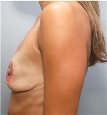 Breast Augmentation Before Photo by Ellen Mahony, MD; Westport, CT - Case 43273