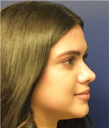 Rhinoplasty After Photo by Richard Reish, MD, FACS; New York, NY - Case 43507