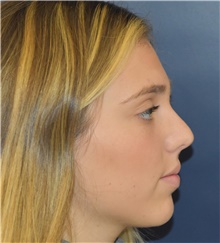 Rhinoplasty Before Photo by Richard Reish, MD, FACS; New York, NY - Case 43543