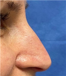 Rhinoplasty Before Photo by Richard Reish, MD, FACS; New York, NY - Case 43563