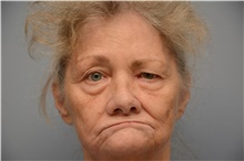 Brow Lift Before Photo by Carlos Rivera-Serrano, MD; ,  - Case 43665
