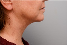 Chin Augmentation After Photo by Carlos Rivera-Serrano, MD; ,  - Case 43671