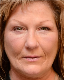 Eyelid Surgery After Photo by Carlos Rivera-Serrano, MD; ,  - Case 43685