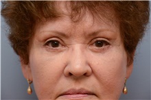 Eyelid Surgery After Photo by Carlos Rivera-Serrano, MD; ,  - Case 43688