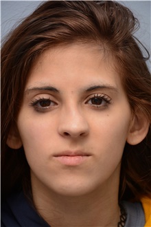 Rhinoplasty Before Photo by Carlos Rivera-Serrano, MD; ,  - Case 43736