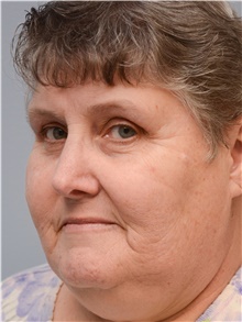 Rhinoplasty After Photo by Carlos Rivera-Serrano, MD; ,  - Case 43740