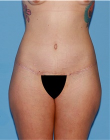 Body Lift After Photo by Siamak Agha, MD PhD FACS; ,  - Case 43874