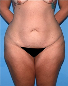 Body Lift Before Photo by Siamak Agha, MD PhD FACS; ,  - Case 43874