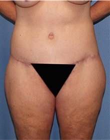 Body Lift After Photo by Siamak Agha, MD PhD FACS; ,  - Case 43878