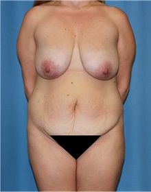 Mommy Makeover Before Photo by Siamak Agha, MD PhD FACS; ,  - Case 43905