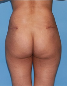 Buttock Lift with Augmentation After Photo by Siamak Agha, MD PhD FACS; ,  - Case 43918