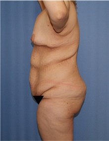 Body Lift Before Photo by Siamak Agha, MD PhD FACS; ,  - Case 43931