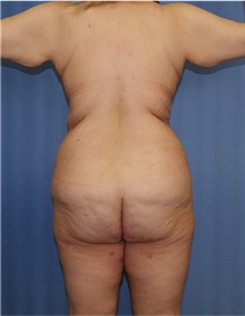 Body Lift Before Photo by Siamak Agha, MD PhD FACS; ,  - Case 43931