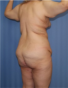 Body Lift Before Photo by Siamak Agha, MD PhD FACS; ,  - Case 43931