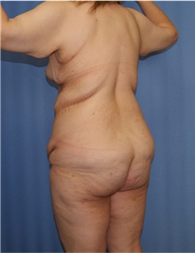 Body Lift Before Photo by Siamak Agha, MD PhD FACS; ,  - Case 43931