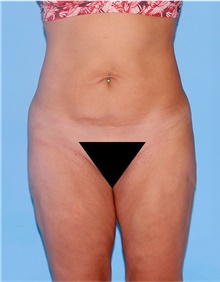 Body Lift Before Photo by Siamak Agha, MD PhD FACS; ,  - Case 43945