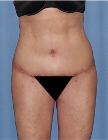 Body Lift After Photo by Siamak Agha, MD PhD FACS; ,  - Case 43947