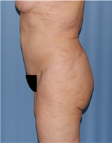 Body Lift Before Photo by Siamak Agha, MD PhD FACS; ,  - Case 43947