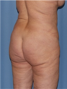 Body Lift Before Photo by Siamak Agha, MD PhD FACS; ,  - Case 43947