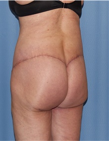 Body Lift After Photo by Siamak Agha, MD PhD FACS; ,  - Case 43947