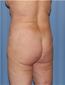 Body Lift Before Photo by Siamak Agha, MD PhD FACS; ,  - Case 43947