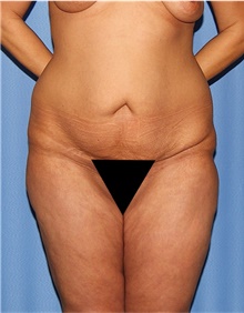 Body Lift Before Photo by Siamak Agha, MD PhD FACS; ,  - Case 43950
