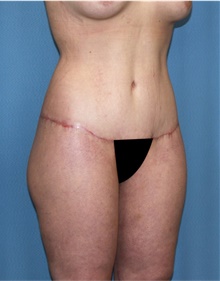 Body Lift After Photo by Siamak Agha, MD PhD FACS; ,  - Case 43951