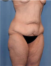 Body Lift Before Photo by Siamak Agha, MD PhD FACS; ,  - Case 43951