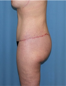 Body Lift After Photo by Siamak Agha, MD PhD FACS; ,  - Case 43951