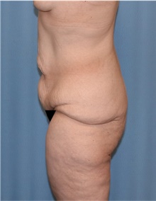 Body Lift Before Photo by Siamak Agha, MD PhD FACS; ,  - Case 43951
