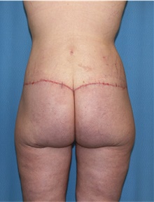 Body Lift After Photo by Siamak Agha, MD PhD FACS; ,  - Case 43951