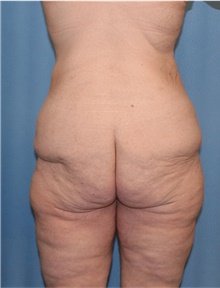 Body Lift Before Photo by Siamak Agha, MD PhD FACS; ,  - Case 43951