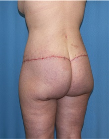 Body Lift After Photo by Siamak Agha, MD PhD FACS; ,  - Case 43951